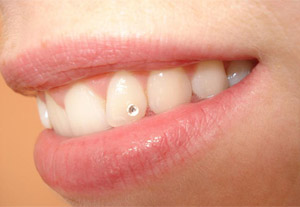 Bijuteriile dentare